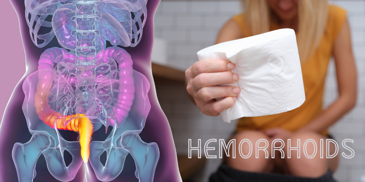 Hemorrhoids