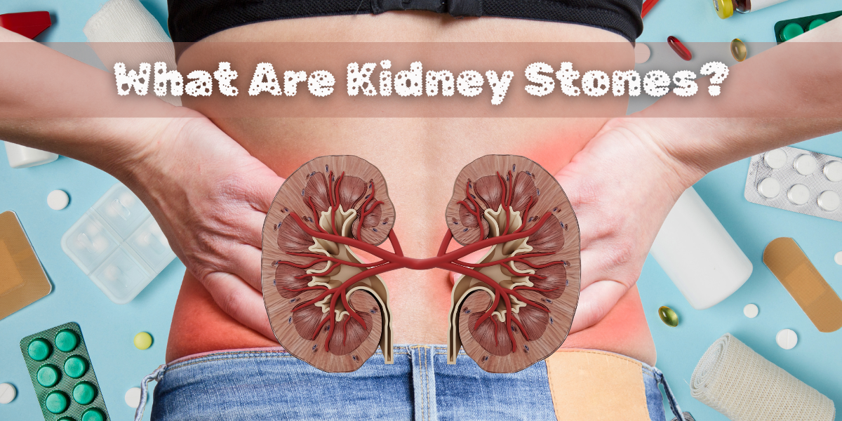 What Are Kidney Stones?