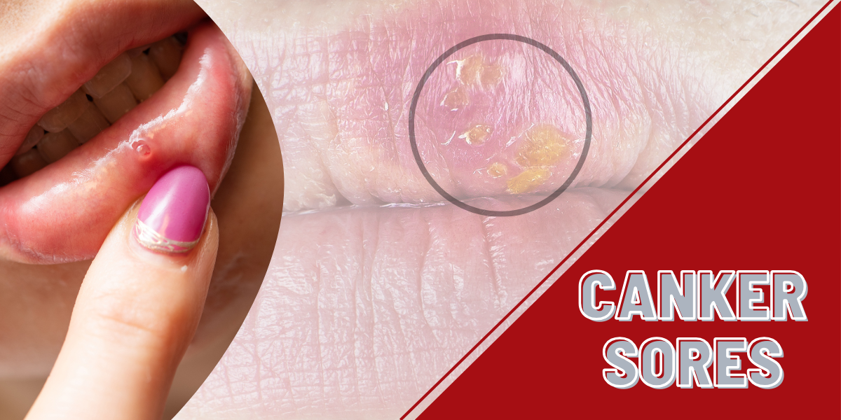 Canker Sores: How to Deal with Recurrent Mouth Sores?